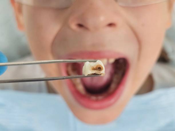 Best Dentist for Tooth Abscess  in Evans, CO